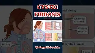 Cystic Fibrosis: A Genetic Battle Against Thick Mucus #cysticfibrosis  #manasstudies #educational