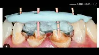 Gigi Tiruan Mahkota Jaket Porselen (Crown) | Dokter Gigi Rizki Dumna
