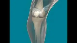 Lesi&oacute;n condral rodilla/Chondral lesion. Knee