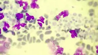 Howell-jolly body in blood smear