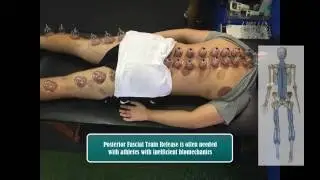 What is Cupping Therapy for Athletes and the Benefits