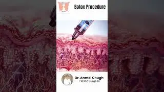 What is Botox & How Does It Work? 💉✨ | Dr. Anmol Chugh