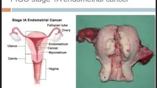 DAROGA Post menopausal bleeding: part 1: differential diagnoses, how to rule out endometrial Cancer?