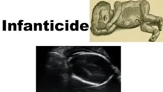 Infanticide- Definition, Still birth, Dead born
