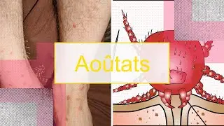 acarien, les aoutats, acarians, los ácaros