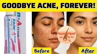 Face Acne: Why It Happens & How to End It for Good (Doctor-Based Guide)