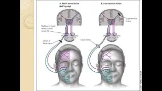 NEUROLOGIE Conduite à tenir devant une paralysie faciale 2016
