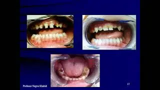 early childhood caries
