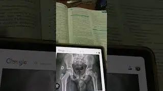 Ch 27 slipped capital femoral epiphysis,Bone and joint disorders,  pediatrics pervez Akbar
