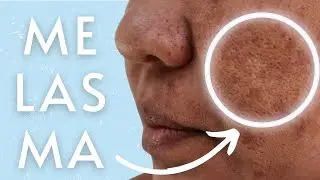 &Aacute;CIDO MAND&Eacute;LICO para clarear melasma e manchas de Acne