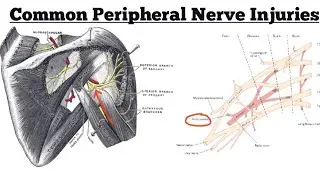 Common Peripheral Nerve Injuries