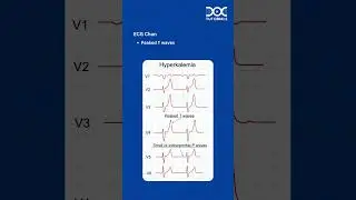 DocTutorials Daily Dose | Topic: Hyperkalemia &ndash; Causes and ECG Changes | Biochemistry