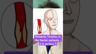 Pulsatile Tinnitus in the Senior patients .. is it Serious ?! #tinnitus #vascular #stroke