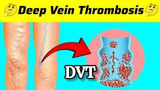 DVT (Deep Vein Thrombosis) Kya Hai? Symptoms, Causes aur Treatment Explained! 