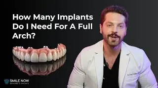 Full Arch Dental Implants: How Many Implants Do I Need?