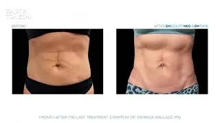 Emsculpt Neo Emtone Treatments at Miami Skin Spa