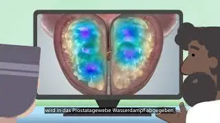 Aufklärungsvideo zur Rezum-Therapie