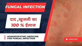 दाद खाज खुजली का 100 % ईलाज I Fungal infection Homeopthic treatment #fungalinfection #khujli