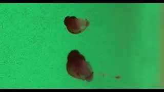 Anoxie verte gauche V2