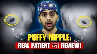 1.5 Months में Puffy Nipple Gone Completely | Puffy Nipple Surgery Results & Review! | Dr DC, Pune