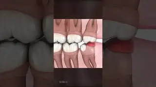 Стоит ли удалять зубы мудрости?