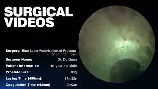 Blue Laser Vaporization of Prostate(BVP) - Dr. Du Quan  80g/25min