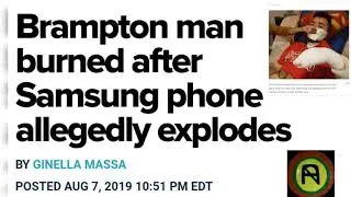 SAMSUNG S5 PHONE EXPLODES & BURST INTO FLAMES & LEAVE BRAMPTON MAN WITH BURNS TO FACE, NECK & HANDS!