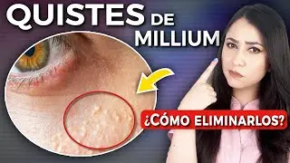 QUISTES DE MILLIUM l ¿Qué son y CÓMO ELIMINARLOS?👩🏻‍⚕️ @Dra. Pau Zúñiga