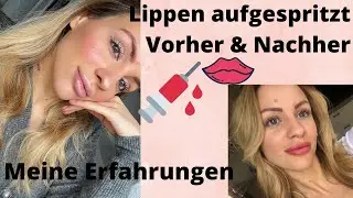 Lippen aufgespritzt 💉👄I VORHER-NACHHER I Meine Erfahrungen...