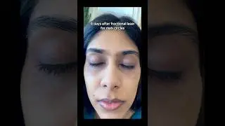Laser for dark circles #darkcircles #darkcirclestreatment