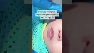 Baby tongue thrust / reverse swallow 👶🏻 #Shorts
