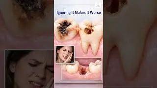 Deep Tooth Decay & Nerve Infection Explained | Root Canal Treatment Saves the Tooth