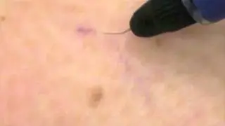 Spider veins being treated by VeinGogh's Ohmic Thermolysis System