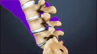 Lumber Facet Arthritis