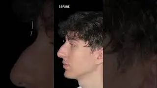 Nose Job Compilation Photos: Before & After #nosejobs