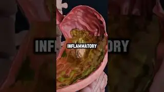 The BEST anti-inflammatory food is.........