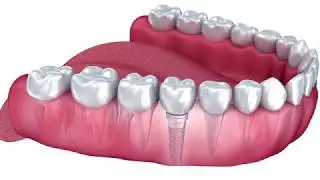 FAQ - What is a dental implant? | Aesthetic & Family Dentistry of Washington