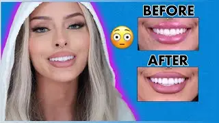I RE DID MY SMILE DESIGN !! * SECOND TIME *  THE AFTER IS CRAZY!