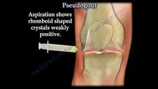 Psuedogout - Everything You Need To Know - Dr. Nabil Ebraheim