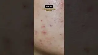 ACNE RED SPOTS | ACNE TREATMENT | RED SPOTS TREATMENT | HEALTHY SKIN | SKIN CARE TIPS #viral