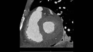 Septal pseudo-aneurysm with VSR  to RV post MI , 80 Kvp , DLP 188 , total radiation 2.7 mSv