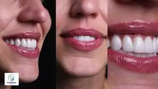 Best Hollywood Smile Clinic in Dubai | Hollywood Smile Veneers | Hollywood Smile Makeover