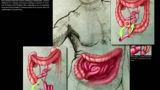 CT Urography After Urinary Diversion and Other Urological Surgical Procedures