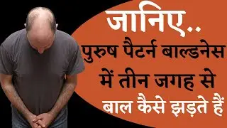 Male Pattern Baldness | Hair Loss | Hair Loss Cure | Baldness | Receding Hairline | Hair Transplant