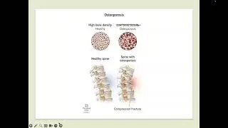 Osteoporosis with Dr. Elizabeth Zavala
