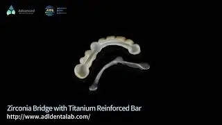 Zircona bridge with titanium reinforced bar