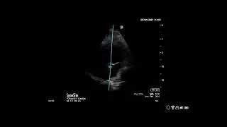 How to... Measure Left Atrial Pressure