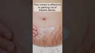 stretch marks cream at home #shorts #youtubeshorts #shortsfeed #stretchmark