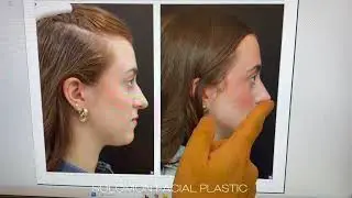 Open Rhinoplasty Before & After (6 Weeks) | Dr. Philip Solomon Toronto