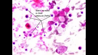 HIV MCQs (For MBBS, USMLE, MCCQE & PLAB)